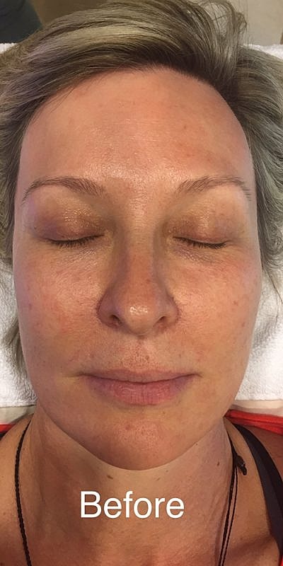 Hydrafacial Before & After